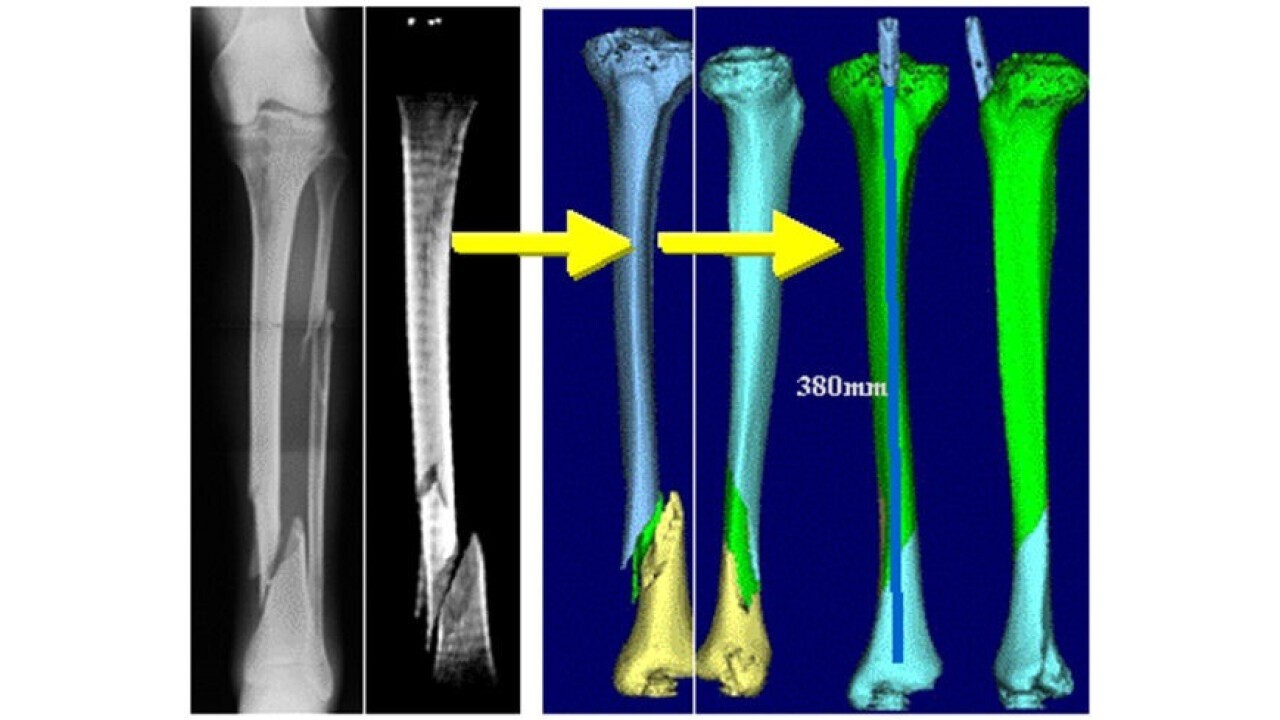 Pre-operative planning - virtual osteosynthesis (Image source - Bern University of Applied Sciences)